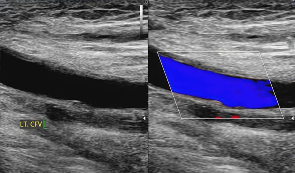 A carotid artery Doppler ultrasound is a diagnostic test used to check the arteries in the neck for diagnosis  any blockage in the veins by a blood clot or “thrombus” formation.