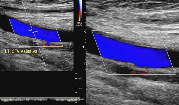 A carotid artery Doppler ultrasound is a diagnostic test used to check the arteries in the neck for diagnosis  any blockage in the veins by a blood clot or “thrombus” formation.