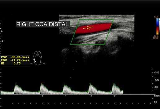 A carotid artery Doppler ultrasound is a diagnostic test used to check the arteries in the neck for diagnosis  any blockage in the veins by a blood clot or “thrombus” formation.