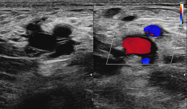 A carotid artery Doppler ultrasound is a diagnostic test used to check the arteries in the neck for diagnosis  any blockage in the veins by a blood clot or “thrombus” formation.