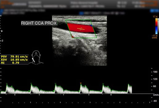 A carotid artery Doppler ultrasound is a diagnostic test used to check the arteries in the neck for diagnosis  any blockage in the veins by a blood clot or “thrombus” formation.