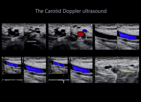 A carotid artery Doppler ultrasound is a diagnostic test used to check the arteries in the neck for diagnosis  any blockage in the veins by a blood clot or “thrombus” formation.