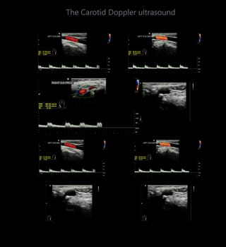 A carotid artery Doppler ultrasound is a diagnostic test used to check the arteries in the neck for diagnosis  any blockage in the veins by a blood clot or “thrombus” formation.