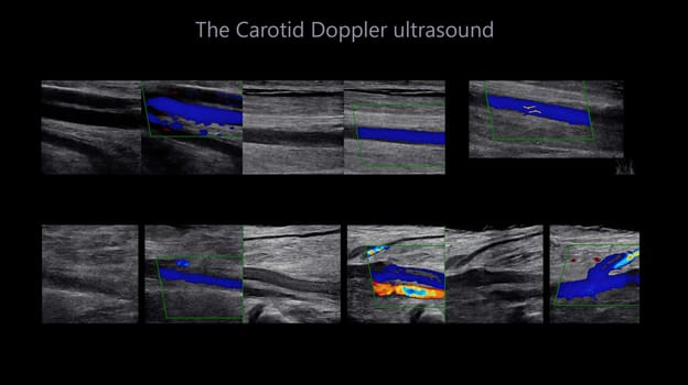 A carotid artery Doppler ultrasound is a diagnostic test used to check the arteries in the neck for diagnosis  any blockage in the veins by a blood clot or “thrombus” formation.