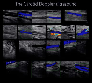 A carotid artery Doppler ultrasound is a diagnostic test used to check the arteries in the neck for diagnosis  any blockage in the veins by a blood clot or “thrombus” formation.