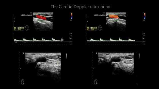 A carotid artery Doppler ultrasound is a diagnostic test used to check the arteries in the neck for diagnosis  any blockage in the veins by a blood clot or “thrombus” formation.