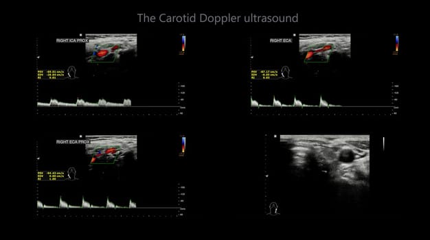 A carotid artery Doppler ultrasound is a diagnostic test used to check the arteries in the neck for diagnosis  any blockage in the veins by a blood clot or “thrombus” formation.