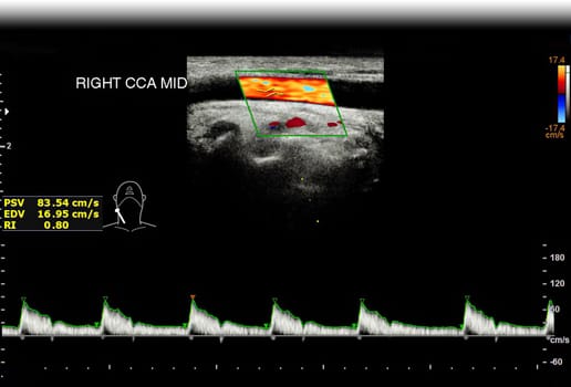 A carotid artery Doppler ultrasound is a diagnostic test used to check the arteries in the neck for diagnosis  any blockage in the veins by a blood clot or “thrombus” formation.