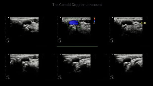 A carotid artery Doppler ultrasound is a diagnostic test used to check the arteries in the neck for diagnosis  any blockage in the veins by a blood clot or “thrombus” formation.