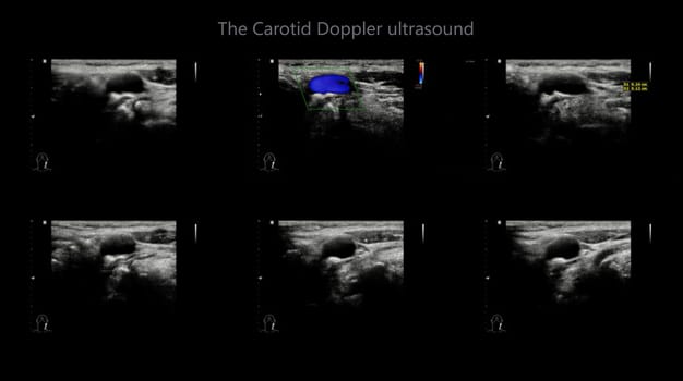 A carotid artery Doppler ultrasound is a diagnostic test used to check the arteries in the neck for diagnosis  any blockage in the veins by a blood clot or “thrombus” formation.