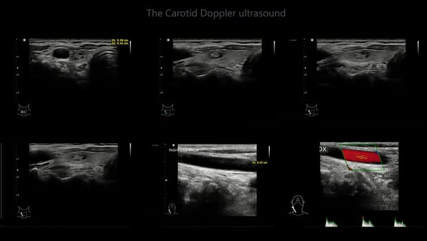 A carotid artery Doppler ultrasound is a diagnostic test used to check the arteries in the neck for diagnosis  any blockage in the veins by a blood clot or “thrombus” formation.