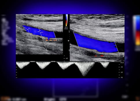 A carotid artery Doppler ultrasound is a diagnostic test used to check the arteries in the neck for diagnosis  any blockage in the veins by a blood clot or “thrombus” formation.