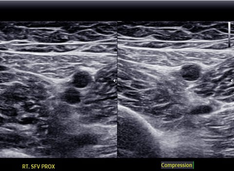 A carotid artery Doppler ultrasound is a diagnostic test used to check the arteries in the neck for diagnosis  any blockage in the veins by a blood clot or “thrombus” formation.