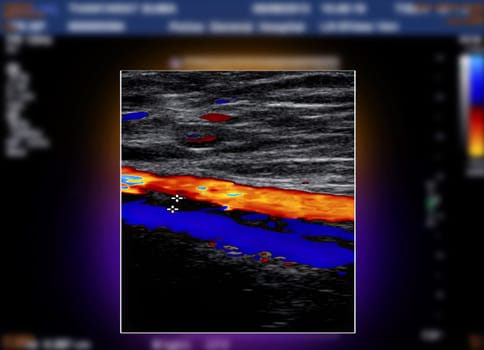 A carotid artery Doppler ultrasound is a diagnostic test used to check the arteries in the neck for diagnosis  any blockage in the veins by a blood clot or “thrombus” formation.