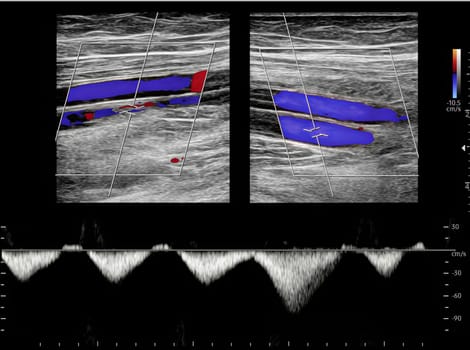 Color Doppler ultrasound determination in deep vein thrombosis patients for finding  deep vein thrombosis of lower extremity.