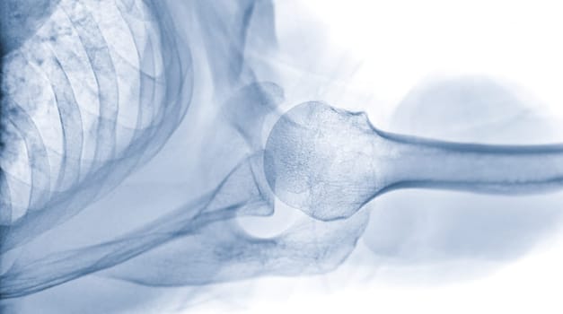 X-ray Shoulder joint shoulder transaxillary view for diagnosis fracture of shoulder joint.