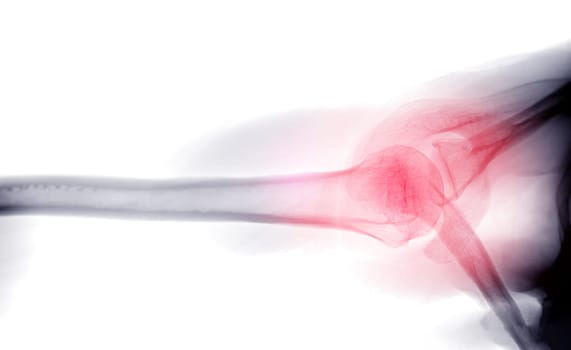 X-ray Shoulder joint shoulder transaxillary view for diagnosis fracture of shoulder joint.