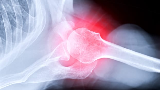 X-ray Shoulder joint shoulder transaxillary view for diagnosis fracture of shoulder joint.