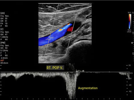 Color Doppler ultrasound determination in deep vein thrombosis patients for finding  deep vein thrombosis of lower extremity.