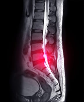 MRI L-S spine or lambar spine sagittal T2 technique for diagnosis spinal cord compression.