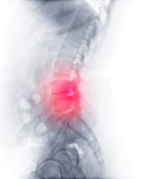 X-ray image of lumbar Spine  or L-s spine  Post operative  Fix Lumbar Plates and screw.