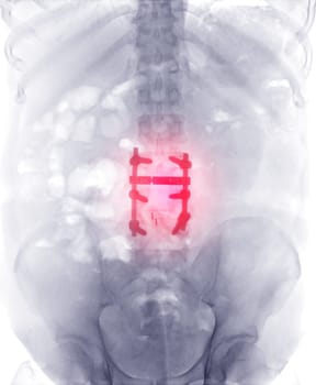 X-ray image of lumbar Spine  or L-s spine  Post operative  Fix Lumbar Plates and screw.