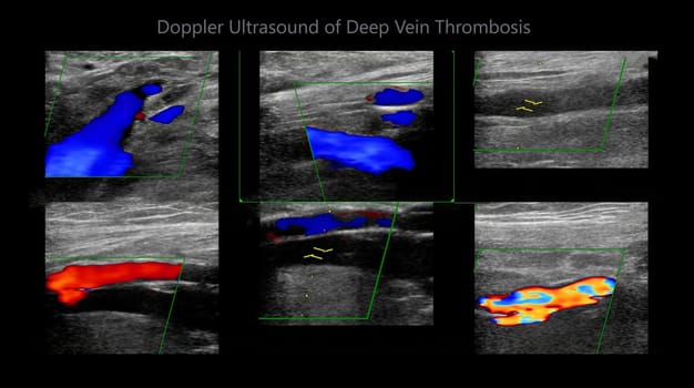 Color Doppler ultrasound determination in deep vein thrombosis patients for finding  deep vein thrombosis of lower extremity.