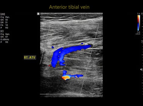 Color Doppler ultrasound determination in deep vein thrombosis patients for finding  deep vein thrombosis of lower extremity.