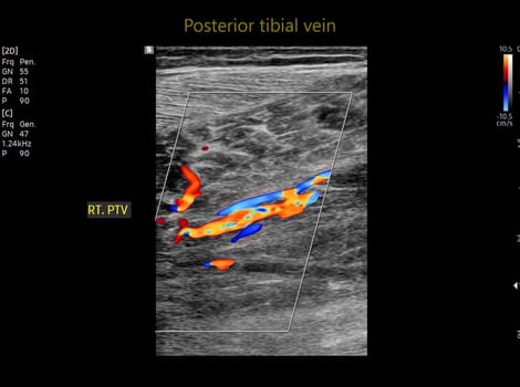 Color Doppler ultrasound determination in deep vein thrombosis patients for finding  deep vein thrombosis of lower extremity.