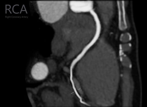  CTA coronary artery Curve refomation showing Right coronary artery .