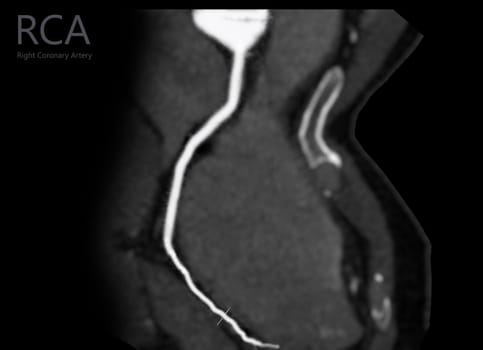  CTA coronary artery Curve refomation showing Right coronary artery .