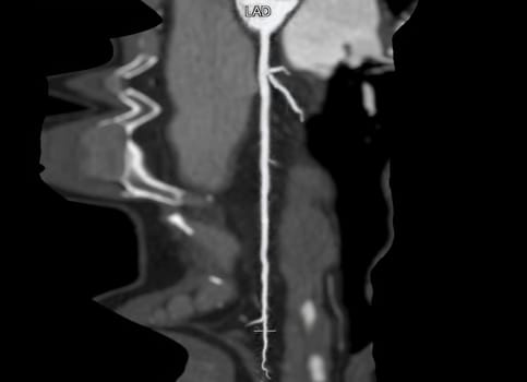  CTA coronary artery Curve refomation showing left coronary artery .