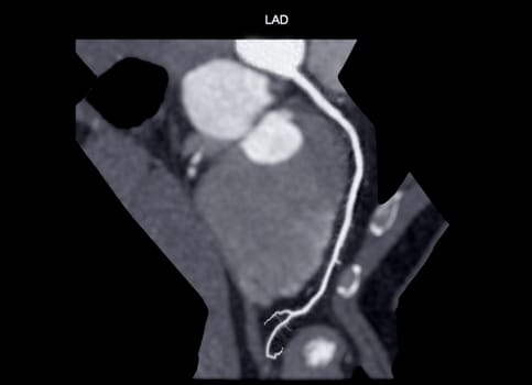  CTA coronary artery Curve refomation showing left coronary artery .