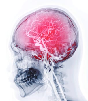  CTA brain or CT angiography of the brain 3D Rendering image fusion with skull lateral view  showing Cerebral artery and common carotid artery in the brain.