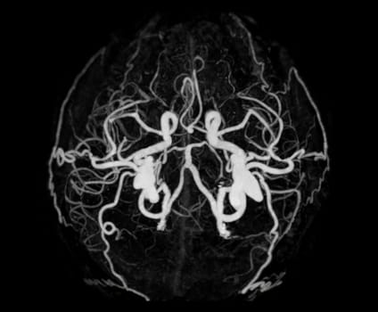 CT angiography of the brain or CTA brain showing Cerebral artery.