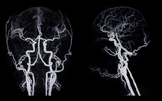 CT angiography of the brain or CTA brain showing Cerebral artery.