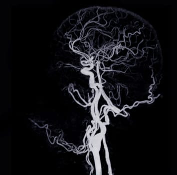 CT angiography of the brain or CTA brain showing Cerebral artery.