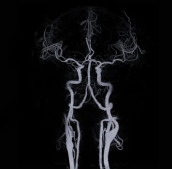 CT angiography of the brain or CTA brain showing Cerebral artery.