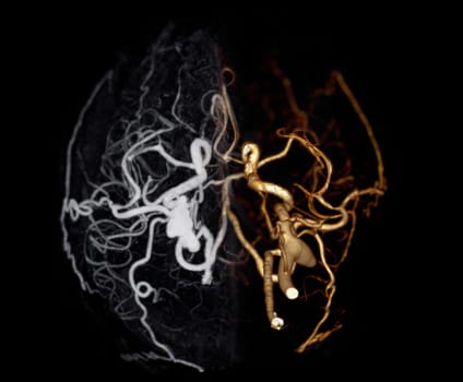 CT angiography of the brain or CTA brain showing Cerebral artery.