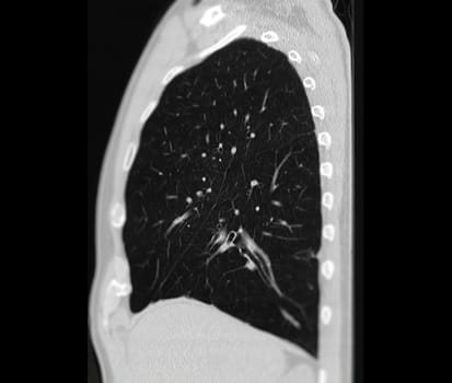 CT scan of Chest or lung for screening lung nodules and lung cancer .