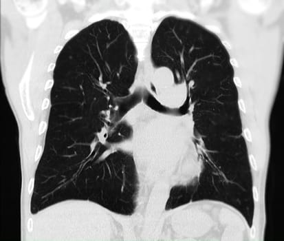 CT scan of Chest or lung for screening lung nodules and lung cancer .