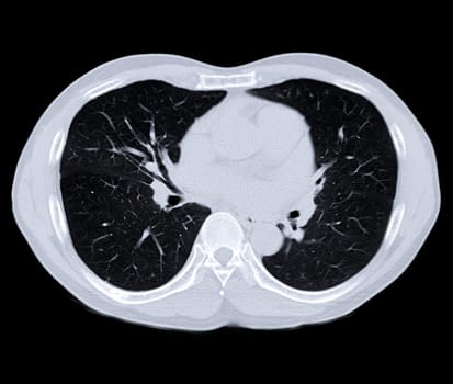 CT scan of Chest or lung for screening lung nodules and lung cancer .