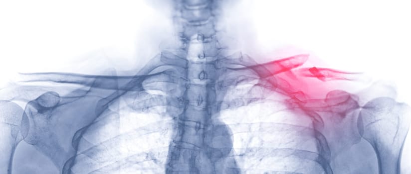 X-ray of Clavicle AP view showing fracture of left Clavicle bone.