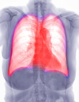 Chest x-ray image Negative filter.