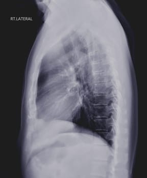 Chest X-ray or X-Ray Image of Human Lung Lateral View with full inspiration for detect heart disease and lung disease . check up concept.