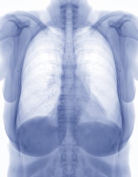 Chest x-ray image Negative filter.