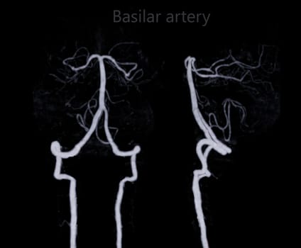 CT angiography of the brain or CTA brain showing basilar artery.