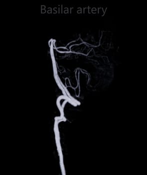 CT angiography of the brain or CTA brain showing basilar artery.