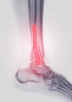  X-ray image of ankle joint showing internal fixation with plate and screw.