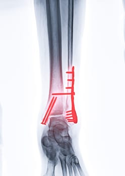  X-ray image of ankle joint showing internal fixation with plate and screw.